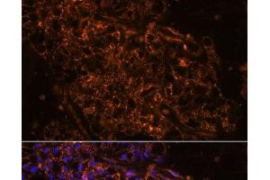 Immunofluorescence analysis of Human kidney cancer using SCNN1G Polyclonal Antibody at dilution of 1:100. (SCNN1G Antikörper)