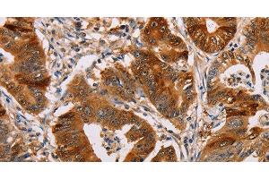 Immunohistochemistry of paraffin-embedded Human gastic cancer using ALDH3A1 Polyclonal Antibody at dilution of 1:55 (ALDH3A1 Antikörper)