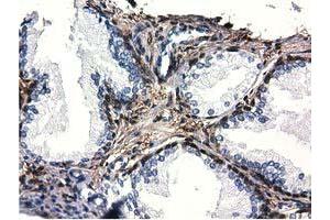 Immunohistochemical staining of paraffin-embedded Adenocarcinoma of Human ovary tissue using anti-QPRT mouse monoclonal antibody. (QPRT Antikörper)