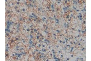 DAB staining on IHC-P; Samples: Human Renal cancer Tissue