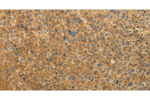 Immunohistochemistry of paraffin-embedded Human liver cancer tissue using RAB35 Polyclonal Antibody at dilution 1:50 (RAB35 Antikörper)