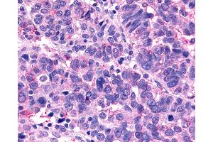 Anti-MRGX1 / MRGPRX1 antibody IHC of human Ovary, Carcinoma. (MRGPRX1 Antikörper  (N-Term))
