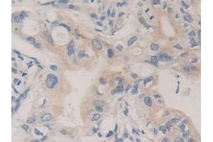 Detection of CPB1 in Human Bile duct cancer Tissue using Polyclonal Antibody to Carboxypeptidase B1, Tissue (CPB1) (CPB1 Antikörper  (AA 111-417))