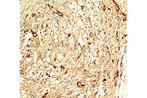 IHC analysis of FFPE human breast carcinoma tissue stained with the MST1 antibody (STK4 Antikörper  (AA 385-415))