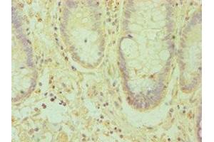 Immunohistochemistry of paraffin-embedded human colon cancer using ABIN7151874 at dilution of 1:100 (Ephrin A1 Antikörper  (AA 19-182))