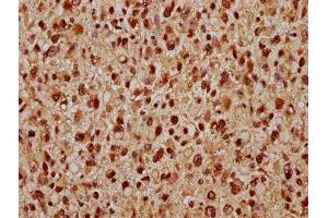 IHC image of ABIN7171666 diluted at 1:300 and staining in paraffin-embedded human glioma performed on a Leica BondTM system. (Tiparp Antikörper  (AA 74-178))