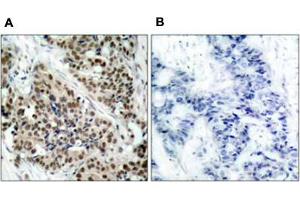 Immunohistochemical staining of paraffin-embbeded human breast carcinoma tissue using FOXO1 (phospho S256) polyclonal antibody  (A) or preincubated with blocking peptide (B). (FOXO1 Antikörper  (pSer256))