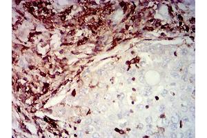 Immunohistochemical analysis of paraffin-embedded lung cancer tissues using CD45 mouse mAb with DAB staining.