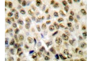 Immunohistochemistry analyzes of Histone H1 antibody in paraffin-embedded human lung carcinoma tissue. (Histone H1 Antikörper)