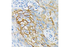 Immunohistochemistry of paraffin-embedded human lung cancer using GRIK2 Rabbit mAb (ABIN7267415) at dilution of 1:100 (40x lens). (GRIK2 Antikörper)