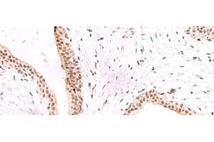 Immunohistochemistry of paraffin-embedded Human breast cancer tissue using CBFA2T2 Polyclonal Antibody at dilution of 1:60(x200) (CBFA2T2 Antikörper)
