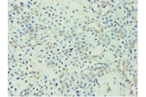 Immunohistochemistry of paraffin-embedded human breast cancer using ABIN7144436 at dilution of 1:100 (APOL1 Antikörper  (AA 179-398))