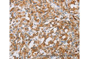 Immunohistochemistry of Human liver cancer using BDH1 Polyclonal Antibody at dilution of 1:60 (BDH1 Antikörper)
