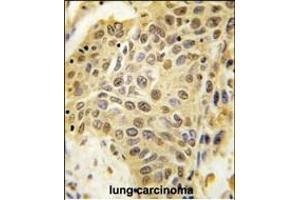 Formalin-fixed and paraffin-embedded human lung carcinoma tissue reacted with SENP5 Antibody (C-term) (ABIN388050 and ABIN2845616) , which was peroxidase-conjugated to the secondary antibody, followed by DAB staining. (SENP5 Antikörper  (C-Term))