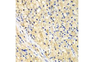 Immunohistochemistry of paraffin-embedded human lung cancer using NUP62 antibody (ABIN5971334) at dilution of 1/100 (40x lens). (NUP62 Antikörper)