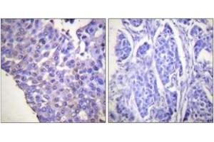 Immunohistochemistry analysis of paraffin-embedded human breast carcinoma, using Caldesmon (Phospho-Ser789) Antibody. (Caldesmon Antikörper  (pSer789))