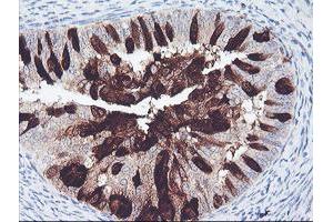 Immunohistochemical staining of paraffin-embedded Adenocarcinoma of Human endometrium tissue using anti-ALOX15 mouse monoclonal antibody. (ALOX15 Antikörper)