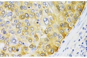 Immunohistochemistry of paraffin-embedded Human liver cancer using PA2G4 Polyclonal Antibody at dilution of 1:100 (40x lens). (PA2G4 Antikörper)