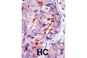 Formalin-fixed and paraffin-embedded human hepatocellular carcinoma tissue reacted with CAMK1D polyclonal antibody  , which was peroxidase-conjugated to the secondary antibody, followed by DAB staining. (CAMK1D Antikörper  (C-Term))