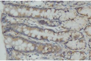ABIN6274989 at 1/100 staining human colon carcinoma tissue sections by IHC-P. (CEP55 Antikörper  (C-Term))
