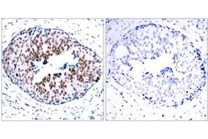Immunohistochemistry analysis of paraffin-embedded human breast carcinoma, using STAT5A (Phospho-Ser780) Antibody. (STAT5A Antikörper  (pSer780))