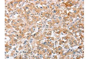 The image on the left is immunohistochemistry of paraffin-embedded Human thyroid cancer tissue using ABIN7131058(SIGLEC9 Antibody) at dilution 1/40, on the right is treated with fusion protein. (SIGLEC9 Antikörper)
