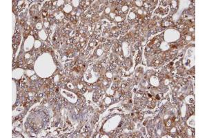 IHC-P Image Immunohistochemical analysis of paraffin-embedded NCI-N87 xenograft, using AKR1C3, antibody at 1:100 dilution. (AKR1C3 Antikörper  (C-Term))