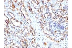 IHC staining of FFPE human angiocarcinoma with CD31 antibody.
