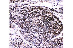 Anti-TRAF4 antibody, IHC(P) IHC(P): Human Lung Cancer Tissue