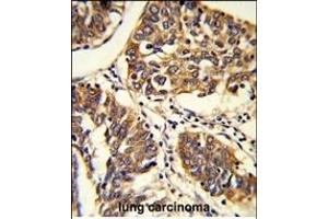 Formalin-fixed and raffin-embedded human lung carcinoma reacted with BPC1 Antibody (Center), which was peroxidase-conjugated to the secondary antibody, followed by DAB staining. (PABP Antikörper  (AA 250-279))