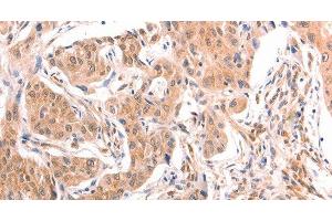 Immunohistochemistry of paraffin-embedded Human lung cancer tissue using TNF beta Polyclonal Antibody at dilution 1:50 (LTA Antikörper)