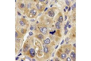 Immunohistochemical analysis of PRODH staining in human liver cancer formalin fixed paraffin embedded tissue section. (PRODH Antikörper)