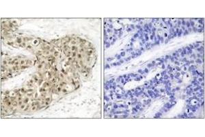 Immunohistochemistry analysis of paraffin-embedded human breast carcinoma, using CDC25C (Phospho-Ser216) Antibody. (CDC25C Antikörper  (pSer216))
