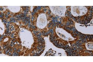 Immunohistochemistry of paraffin-embedded Human colon cancer using NDUFA4 Polyclonal Antibody at dilution of 1:40 (NDUFA4 Antikörper)