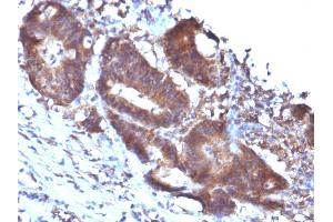 Formalin-fixed, paraffin-embedded human Colon Carcinoma stained with Transgelin Monoclonal Antibody (TAGLN/247) (Transgelin Antikörper)