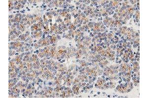 Immunohistochemical staining of paraffin-embedded Carcinoma of Human thyroid tissue using anti-LACTB2 mouse monoclonal antibody. (LACTB2 Antikörper)