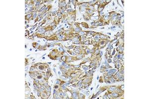Immunohistochemistry of paraffin-embedded human esophageal cancer using CC2D1A Rabbit pAb (ABIN1679010, ABIN3019218, ABIN3019219 and ABIN6220767) at dilution of 1:200 (40x lens). (CC2D1A Antikörper  (AA 1-150))
