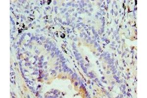 Immunohistochemistry of paraffin-embedded human lung cancer using ABIN7152008 at dilution of 1:100 (Stomatin Antikörper  (AA 55-288))