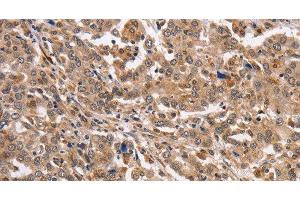 Immunohistochemistry of paraffin-embedded Human liver cancer using KCNG2 Polyclonal Antibody at dilution of 1:40 (Kcng2 Antikörper)