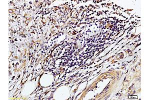 Formalin-fixed and paraffin embedded human colon carcinoma labeled with Rabbit Anti-TIMP-1(NT) Polyclonal Antibody, Unconjugated (ABIN668331) at 1:200 followed by conjugation to the secondary antibody and DAB staining. (TIMP1 Antikörper  (AA 103-207))