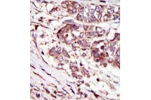 Formalin-fixed and paraffin-embedded human cancer tissue (hepatocarcinoma) reacted with the primary antibody, which was peroxidase-conjugated to the secondary antibody, followed by AEC staining. (CAMK1G Antikörper  (C-Term))