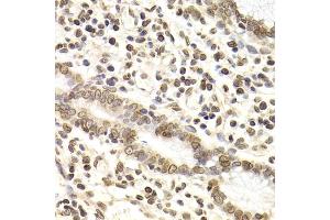 Immunohistochemistry of paraffin-embedded human gastric cancer using LMNB2 Antibody (ABIN2563696) at dilution of 1:200 (40x lens). (Lamin B2 Antikörper)