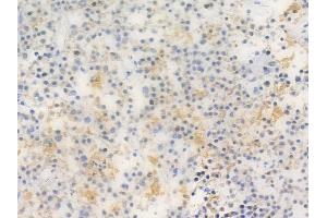 PSD93 Antibody at 1/100 staining human pituitary adenoma by IHC-P.