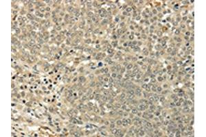 The image on the left is immunohistochemistry of paraffin-embedded Human ovarian cancer tissue using ABIN7128017(SIAH1 Antibody) at dilution 1/35, on the right is treated with fusion protein. (SIAH1 Antikörper)