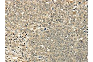 The image on the left is immunohistochemistry of paraffin-embedded Human ovarian cancer tissue using ABIN7128017(SIAH1 Antibody) at dilution 1/35, on the right is treated with fusion protein.