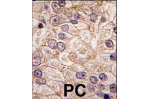 Formalin-fixed and paraffin-embedded human prostate carcinoma tissue reacted with PI4K2B polyclonal antibody  , which was peroxidase-conjugated to the secondary antibody, followed by DAB staining. (PI4K2B Antikörper  (N-Term))