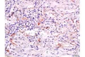 Formalin-fixed and paraffin embedded human lung carcinoma labeled with Anti-GRASP Polyclonal Antibody, Unconjugated  at 1:200 followed by conjugation to the secondary antibody and DAB staining.