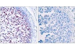 Immunohistochemistry analysis of paraffin-embedded human breast carcinoma, using c-Jun (Phospho-Thr239) Antibody. (C-JUN Antikörper  (pThr239))
