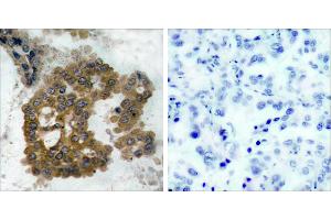 P-Peptide - +Immunohistochemical analysis of paraffin-embedded human lung carcinoma tissue using Akt2 (phospho- Ser474) antibody. (AKT2 Antikörper  (pSer474))