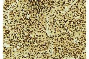 ABIN6277089 at 1/100 staining Human breast cancer tissue by IHC-P. (PIN1 Antikörper  (N-Term))